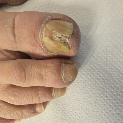 Paznokcie zmienione chorobowo