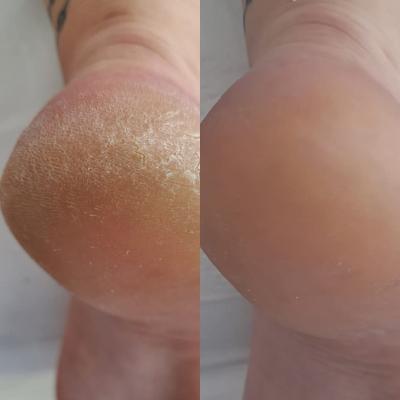 Efekty po pierwszym zabiegu